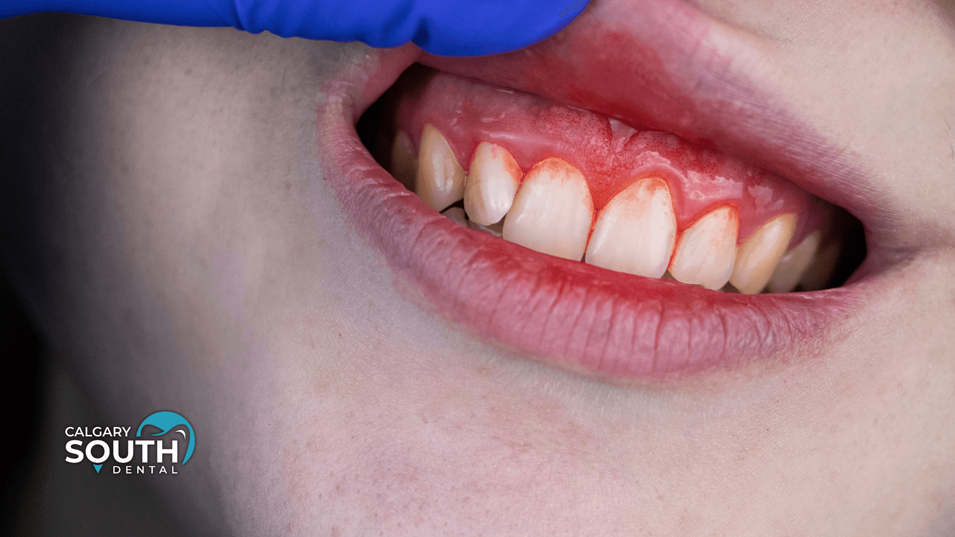 Can Whitening Cause Gum Irritation_ What to Do