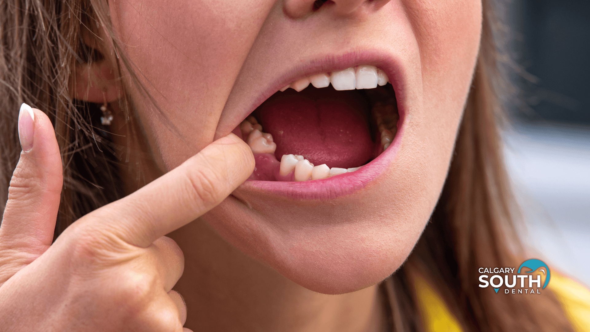 What to Know About Overeruption After Tooth Loss
